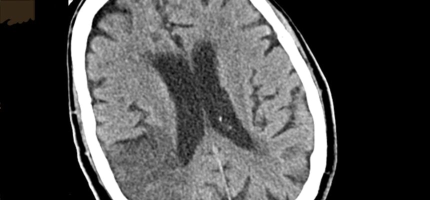 Which symptoms will most probably be observed in a patient with the following CT image?