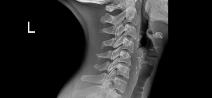 X-ray of the Cervical Spine