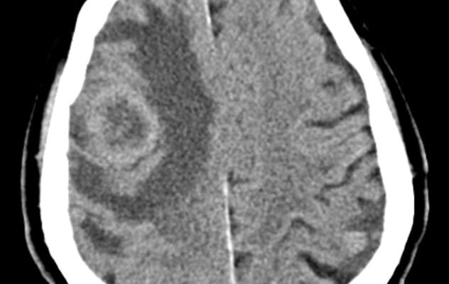 Q 2.22. Cerebral tumors: classification, clinical symptoms, diagnosis, differential diagnosis. Syndromes of intracranial hypertension.
